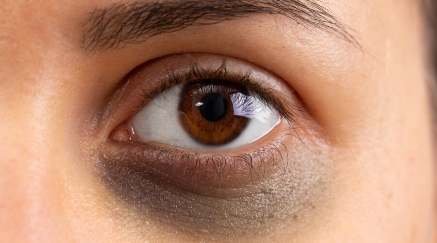 الهالات السوداء تحت العين