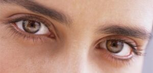 الهالات السوداء تحت العين