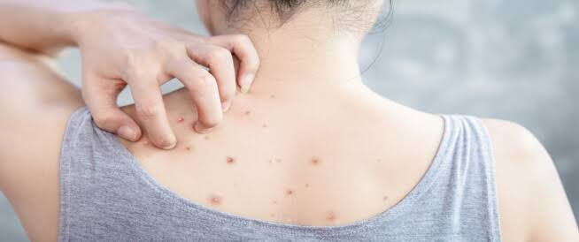 ظهور الحبوب في الظهر والصدر