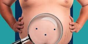 عملية تكميم المعدة