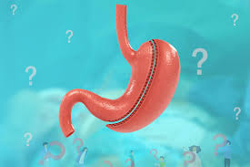 عملية تكميم المعدة