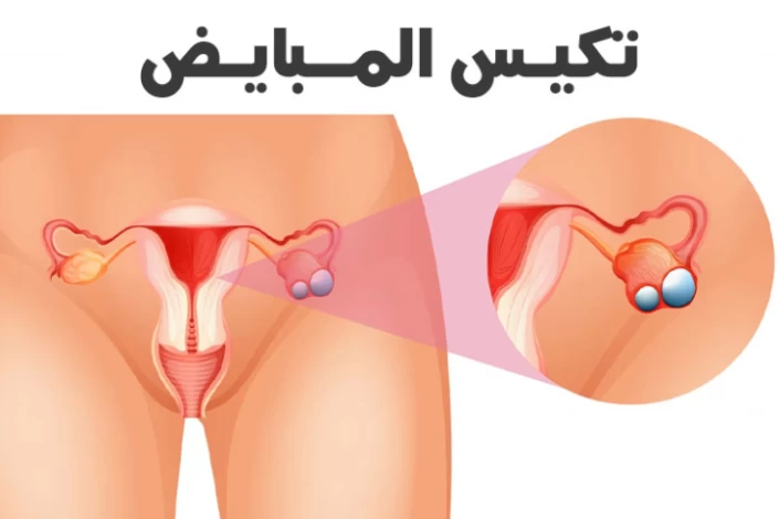 علاج تكيسات المبايض