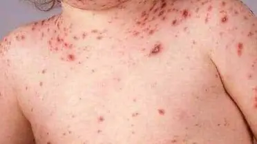 وباء الحصبة