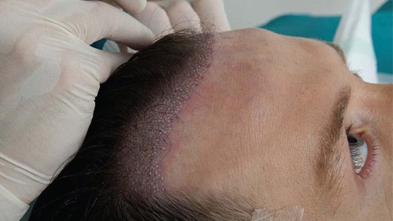 أضرار زراعة الشعر للرجال