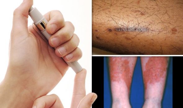 أعراض ارتفاع سكر الدم