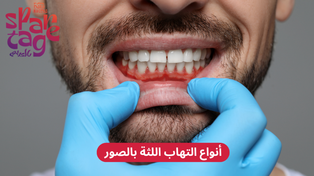 أنواع التهاب اللثة بالصور