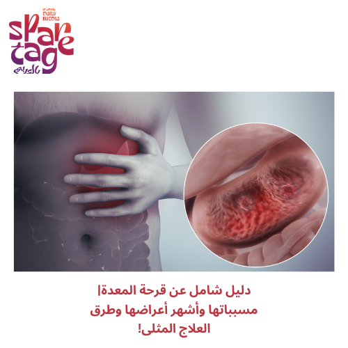 دليل شامل عن قرحة المعدة مسبباتها وأشهر أعراضها وطرق العلاج المثلى!