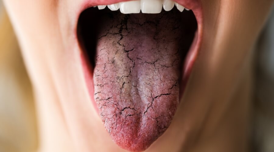 سبب جفاف الفم