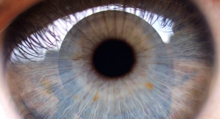 عيوب زراعة العدسات