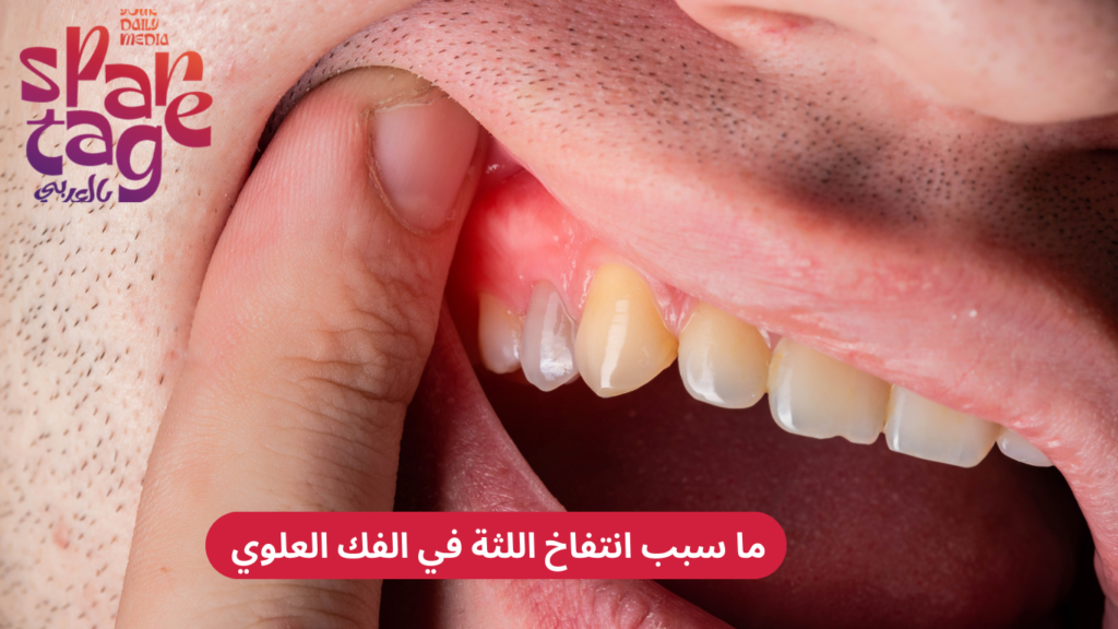 ما سبب انتفاخ اللثة في الفك العلوي