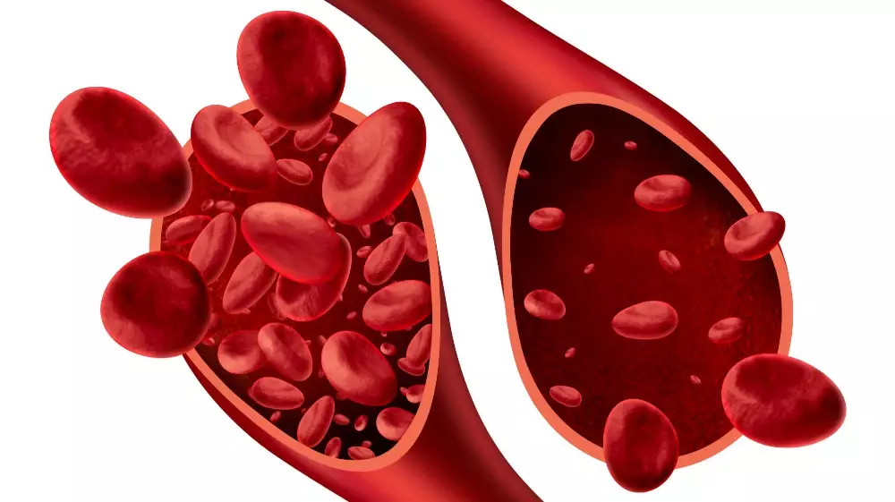 الأنيميا الحادة