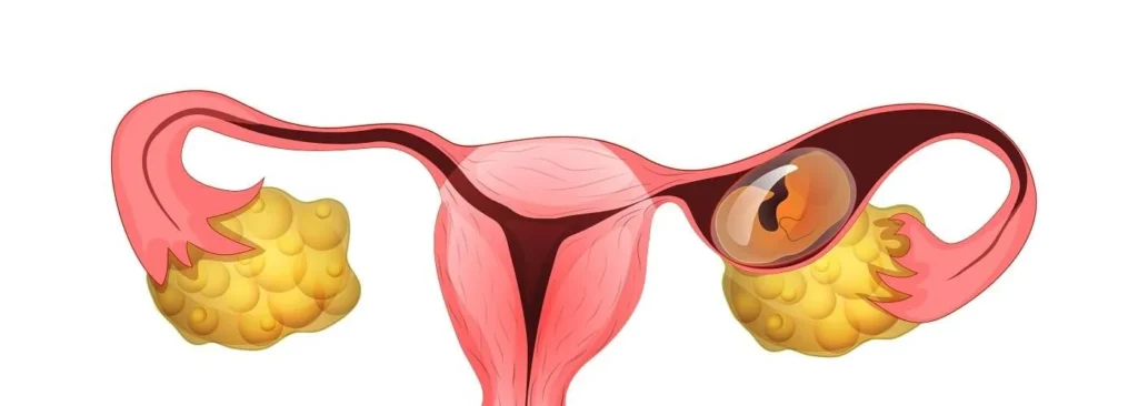 حمل خارج الرحم