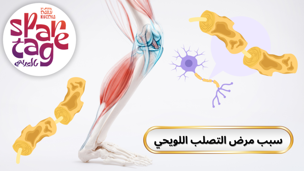 ما هو مرض التصلب اللويحي 