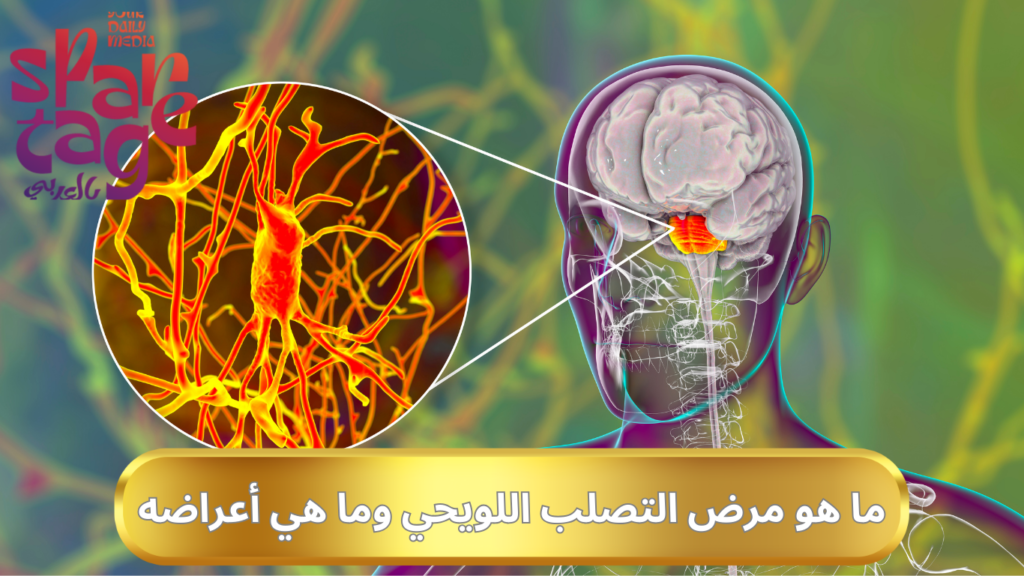 ما هو مرض التصلب اللويحي 