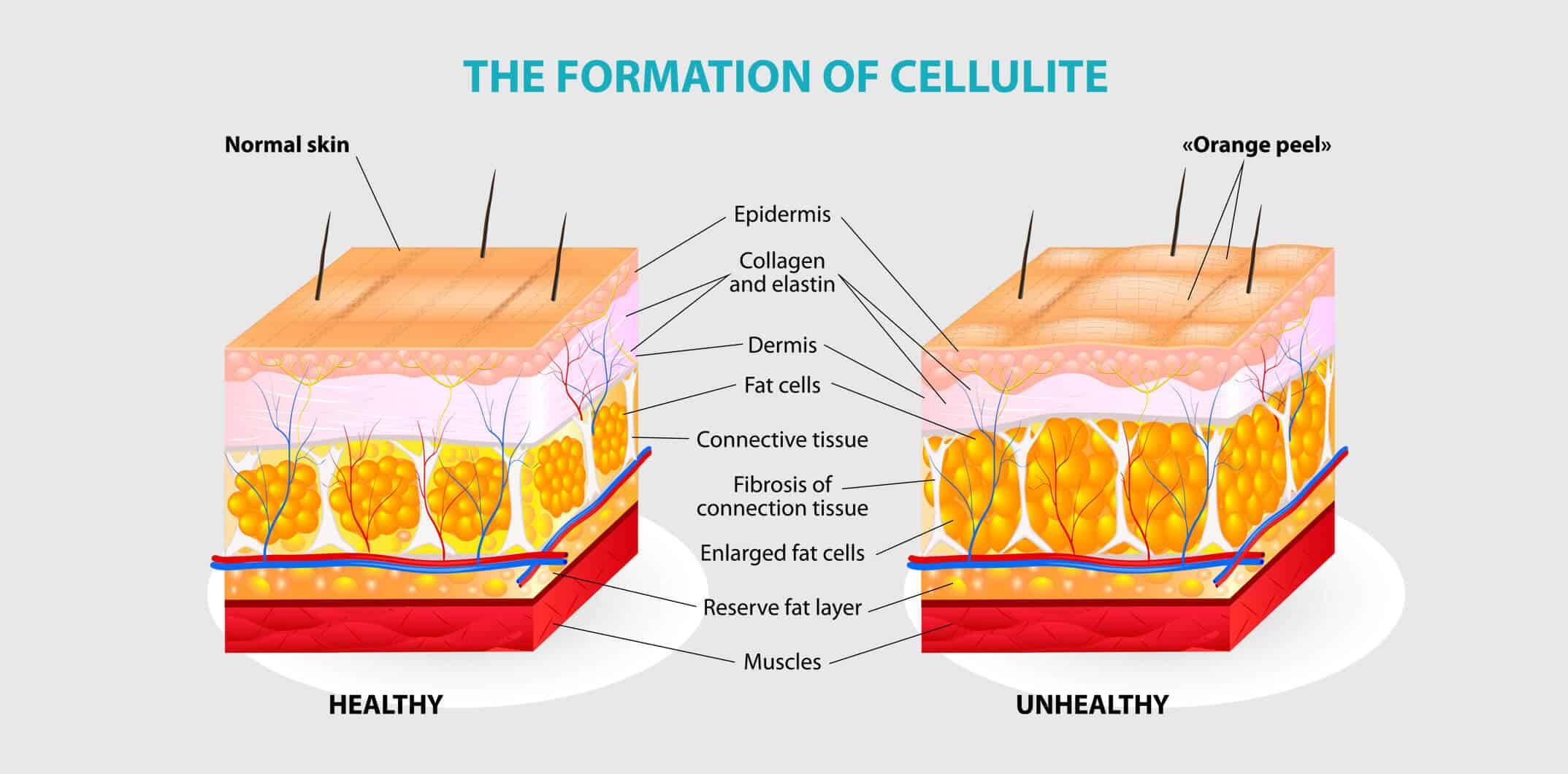 متى تظهر نتيجة حقن الميزوثيرابي للتخسيس