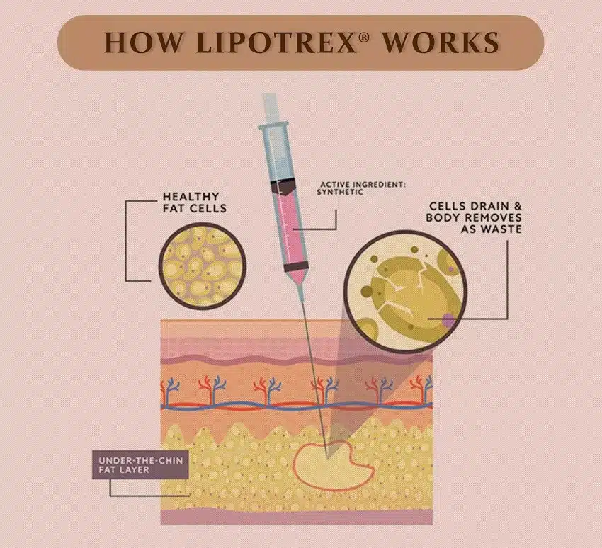 متى تظهر نتيجة حقن الميزوثيرابي للتخسيس