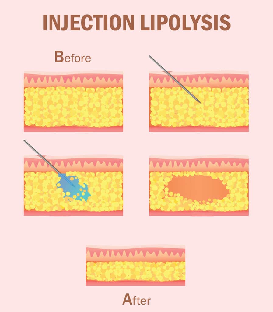 متى تظهر نتيجة حقن الميزوثيرابي للتخسيس