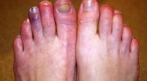 أسباب برودة القدمين عند النوم 