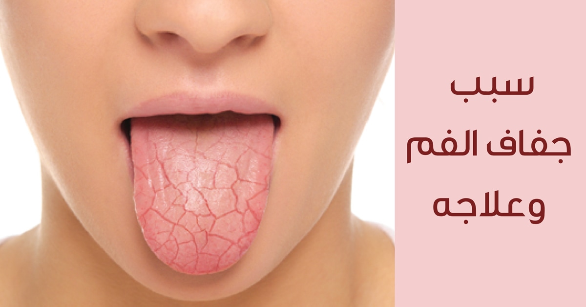أسباب جفاف الفم عند النساء