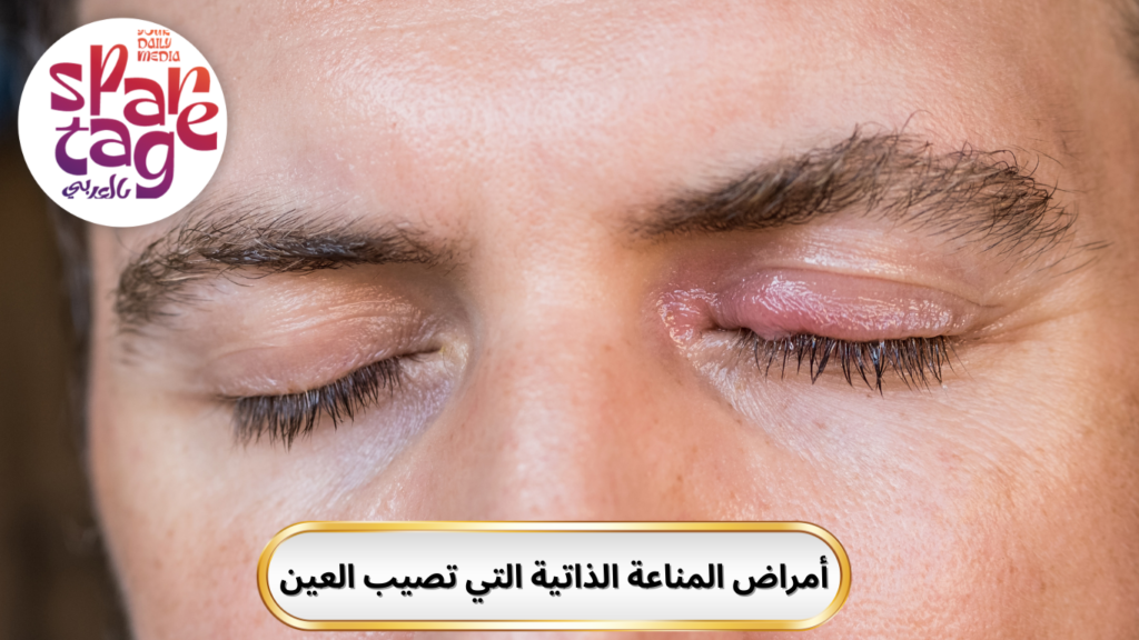 امراض المناعة الذاتية 