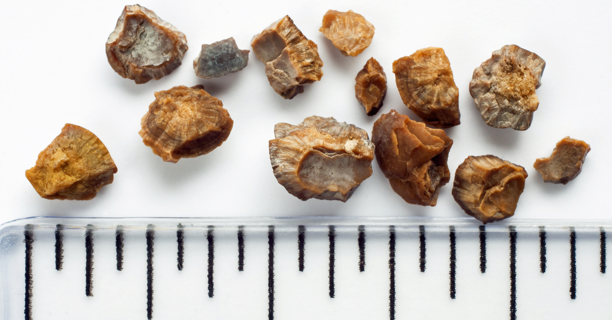 حجم حصى الكلى