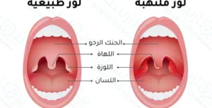 علاج احتقان الزور