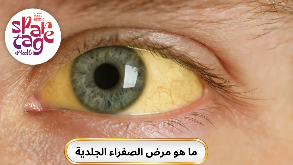 مرض الصفراء الجلدية