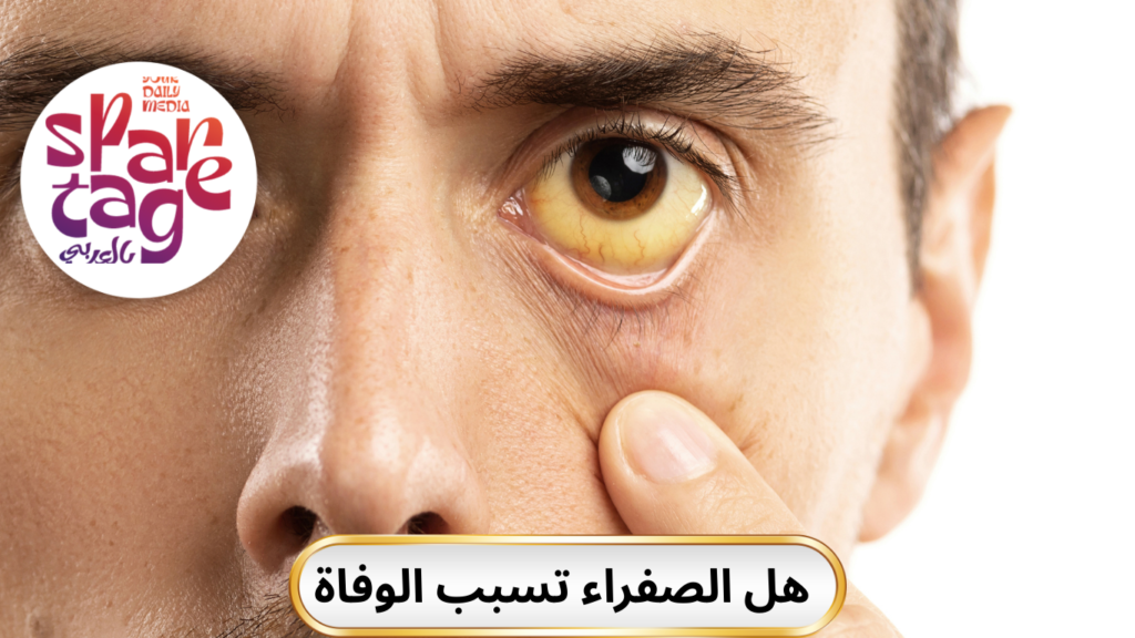 مرض الصفراء الجلدي