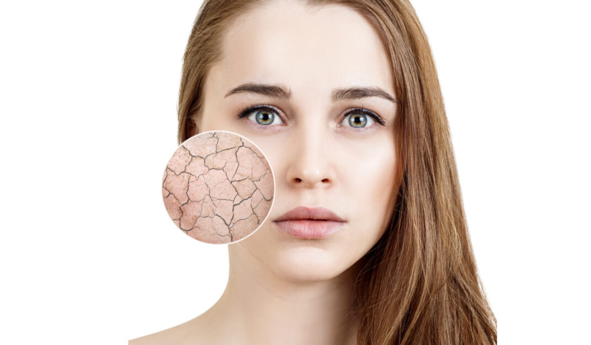جفاف البشرة