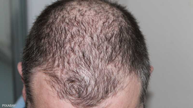 علاج تساقط الشعر الوراثي