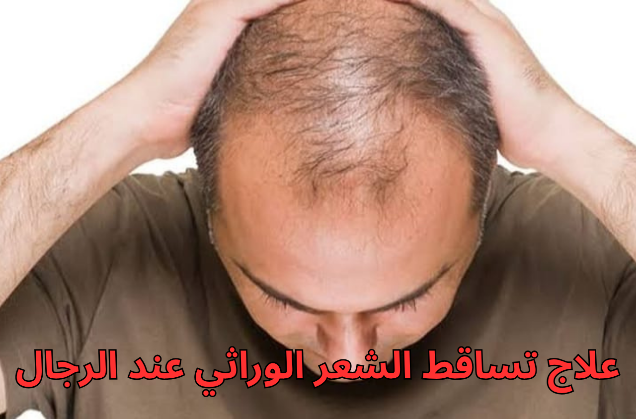 مشكلة تساقط الشعر الوراثي عند الرجال