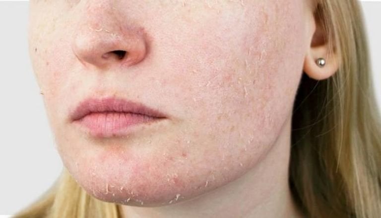 كيف احمي بشرتي من الجفاف في فصل الشتاء