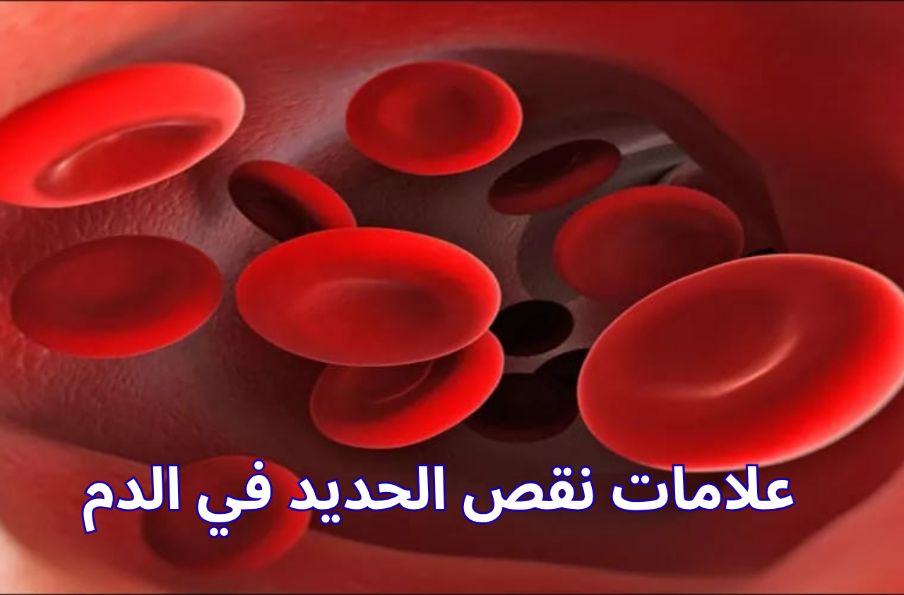 علامات نقص الحديد في الدم