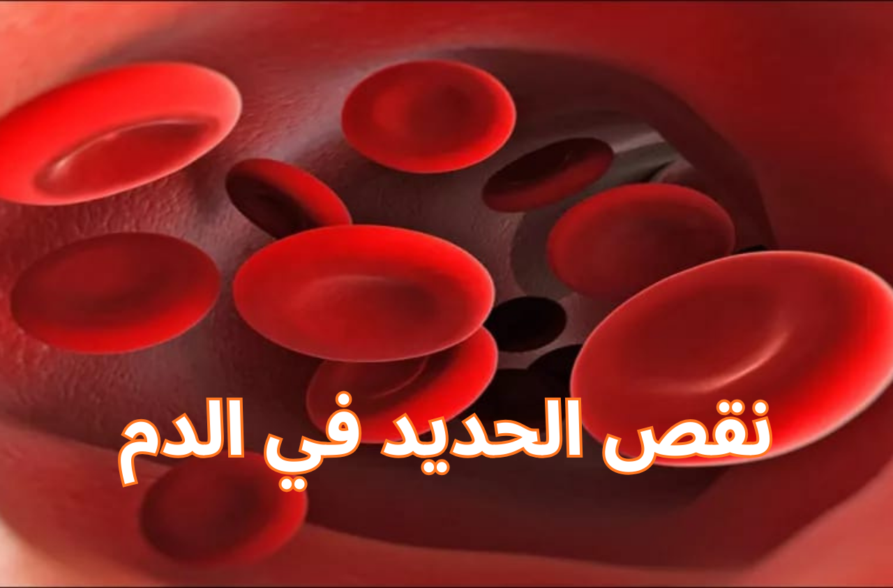 نقص الحديد في الدم