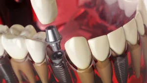 أفضل دول لزراعة الأسنان بأسعار مناسبة