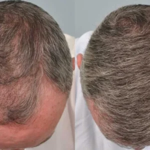 تكلفة زراعة الشعر وأفضل الدول لإجرائها