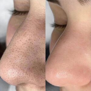 أفضل طرق تنظيف المسام